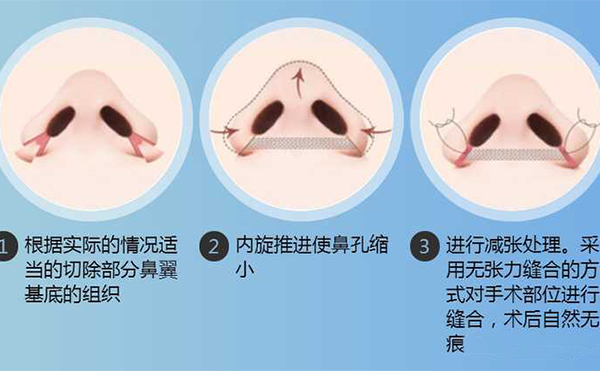 鼻翼縮小手術有用嗎？