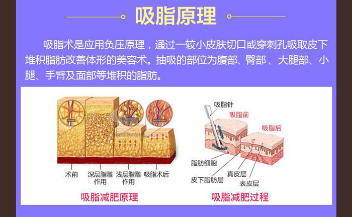 水動(dòng)力吸脂效果好嗎？