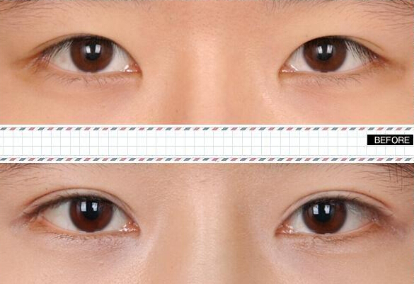 做雙眼皮價格是多少？哪種眼睛適合做雙眼皮呢?