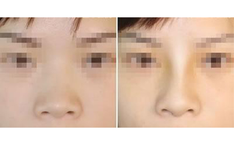 做隆鼻手術(shù)會留疤嗎？