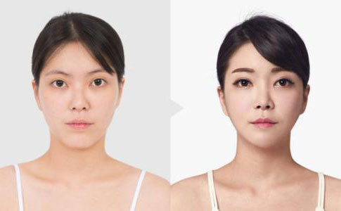 韓式埋線雙眼皮多久恢復(fù)自然？
