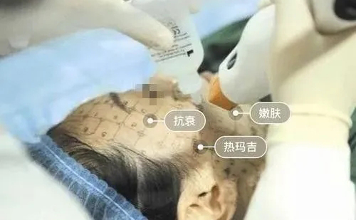 牙齒矯正期間是不能做熱瑪吉嗎？