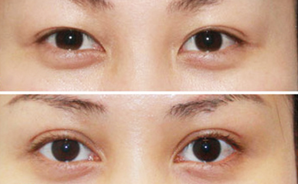 內(nèi)雙做雙眼皮是什么價(jià)格？效果怎么樣？