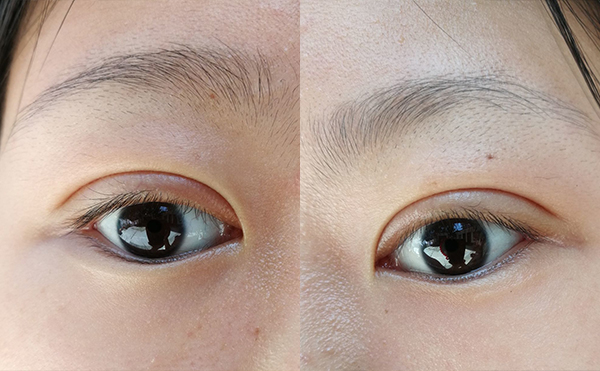 雙眼皮術(shù)后有肉條怎么辦?什么時候修復(fù)效果好?
