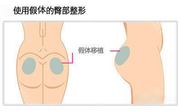 假體豐臀多少錢？假體豐臀效果是永久的嗎？