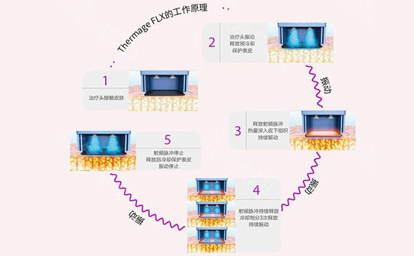 電波拉皮怎么去除魚(yú)尾紋？