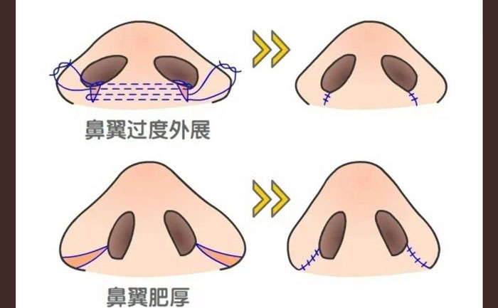 鼻頭肥大怎么改善？鼻頭肥大矯正術(shù)多少錢？