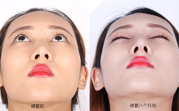 隆鼻手術(shù)失敗怎么辦？修復(fù)費用要多少？