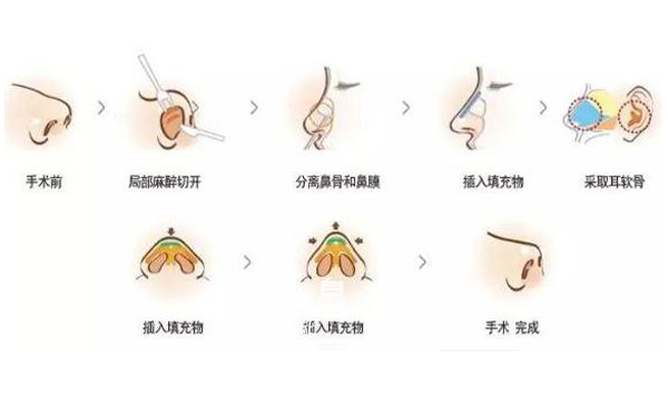 耳軟骨隆鼻效果怎么樣？要多少錢？