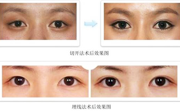 雙眼皮埋線和切開哪個比較好?疼痛程度有什么不同？