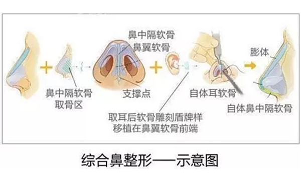 為什么都建議做鼻綜合手術(shù)？