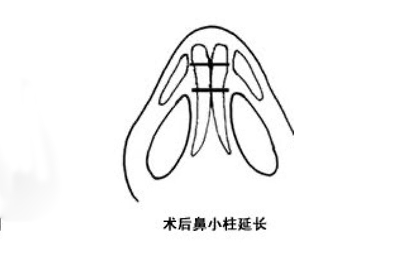 鼻小柱延長可靠嗎？手術(shù)難度大嗎