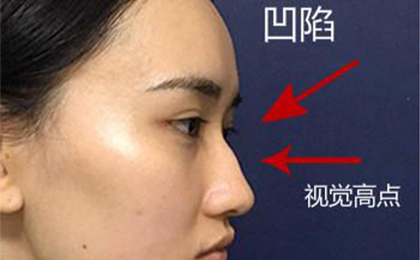駝峰鼻整形是怎么做的？不同嚴(yán)重程度的駝峰鼻矯正方法一樣嗎？