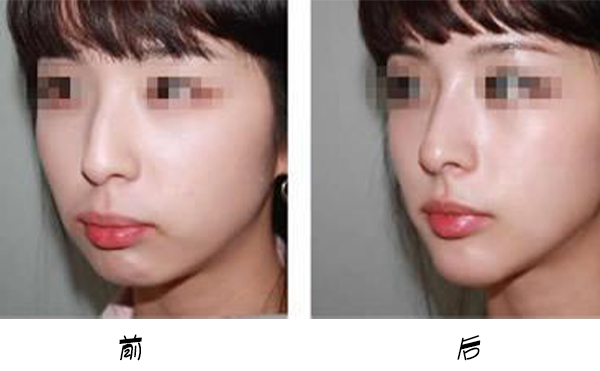 箭鼻是怎么出現(xiàn)的?箭鼻矯正是如何操作的？