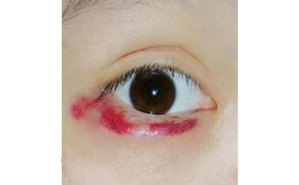 自體脂肪豐臥蠶有風(fēng)險嗎?術(shù)后怎么護(hù)理?