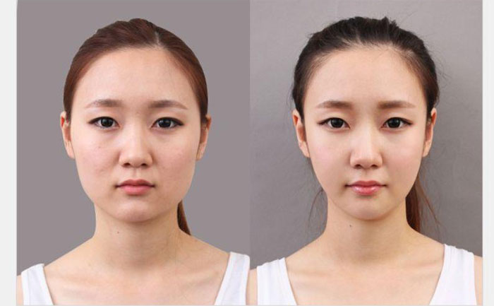非手術(shù)瘦臉多少錢？非手術(shù)瘦臉方法有哪些？