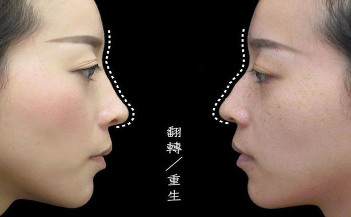 駝峰鼻矯正手術(shù)多少錢？駝峰鼻怎么改善？