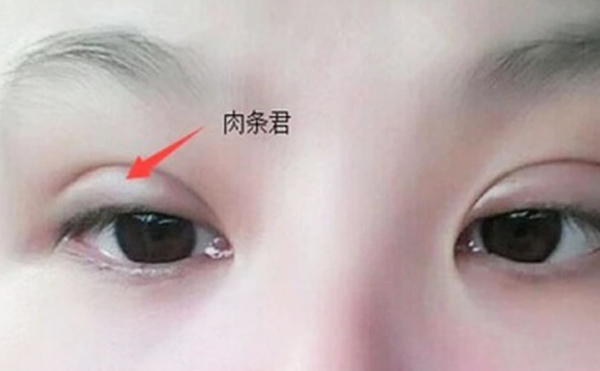 雙眼皮不自然怎么補(bǔ)救？雙眼皮肉條好修復(fù)么？