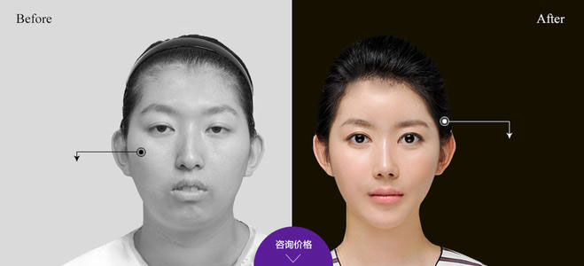 下頜角整形的方法有哪些？