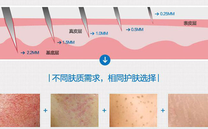 微針去痘坑多少錢一次？