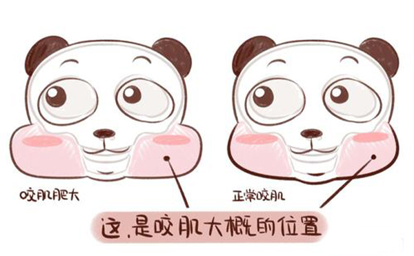 造成咬肌肥大的原因是什么？