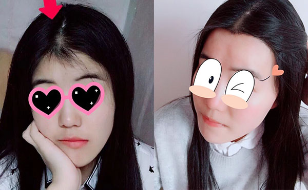 冰點脫毛發(fā)際線怎么樣？