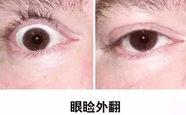 醫(yī)美技術(shù)越來越發(fā)達(dá)，不少愛美的人本著變美的心情滿懷期待地去做雙眼皮、開眼角等項(xiàng)目，不料整容不成、反倒毀容，后悔也來不及。有些做雙眼皮的姑娘術(shù)后出現(xiàn)眼瞼外翻的情況，那眼瞼外翻是什么意思?上眼瞼外翻如何修復(fù)?