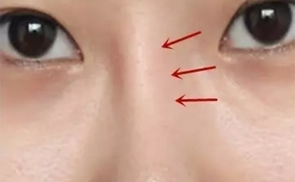 假體隆鼻時間長了出現(xiàn)假體移位等并發(fā)癥后該怎么辦？