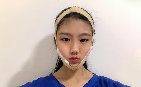 想要確保下頜角整形手術順利和術后效果，術前應該做哪些攻略?