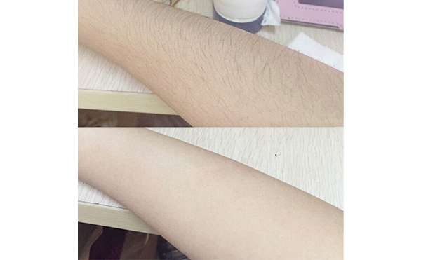 光子手臂脫毛效果怎么樣？