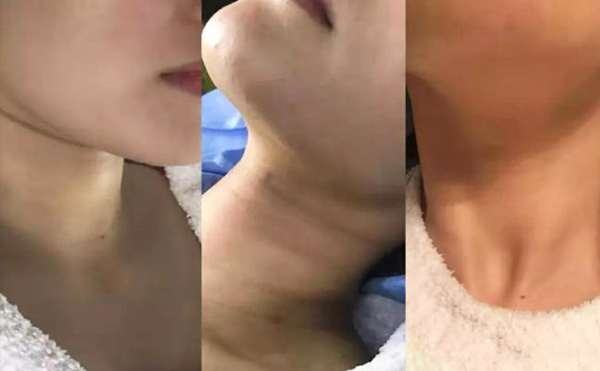 激光去頸紋多少錢？