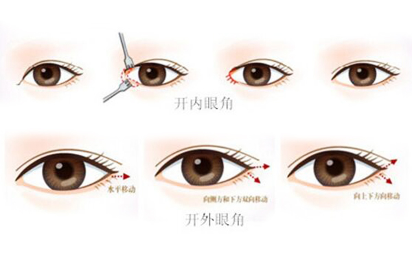 開內眼角和外眼角有什么區(qū)別?開內眼角需要注意什么?