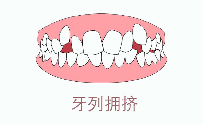 矯正牙齒擁擠度怎么算？