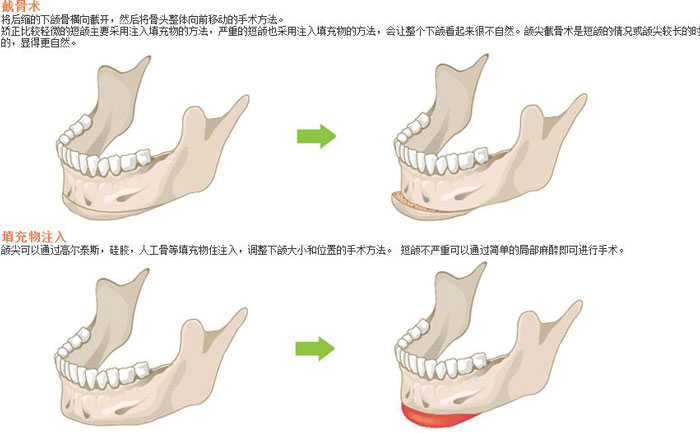 下頜角切除術(shù)一般多少錢？下頜角切除有后遺癥嗎？