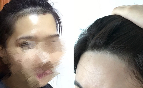 冰點面部脫毛有沒有疼痛感？
