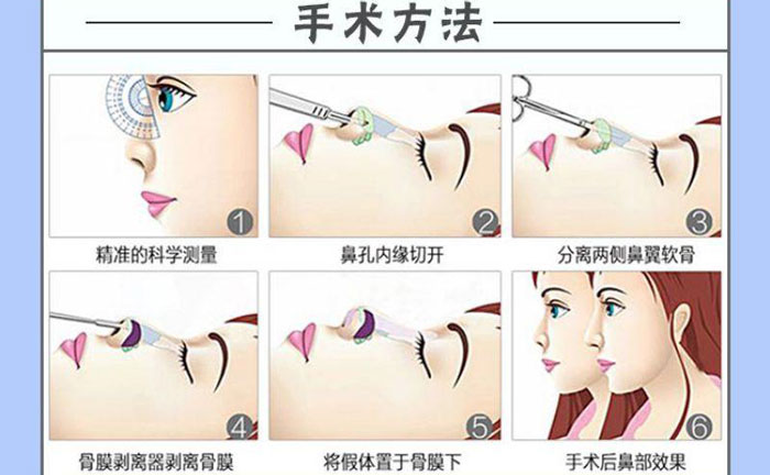隆鼻假體取出后能恢復(fù)到以前嗎？