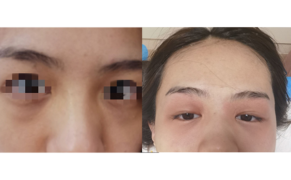 光子嫩膚去黑眼圈怎么樣？