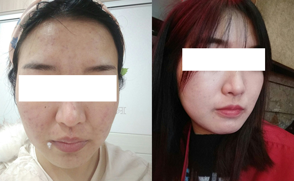 美白針可以維持多久？