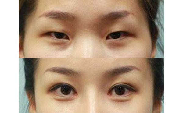 眼綜合手術(shù)多久能恢復(fù)自然？