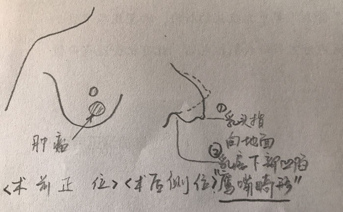 乳房畸形是什么原因造成的？乳房畸形矯正手術(shù)方法？