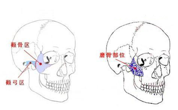 顴骨整形一般是從哪里切口？