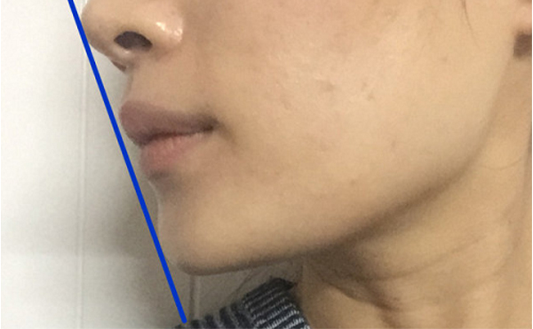 做假體墊下巴恢復(fù)后會(huì)被摸出來(lái)做過(guò)嗎？還能打玻尿酸嗎？