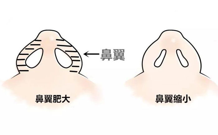 鼻翼縮小手術(shù)要做多久？