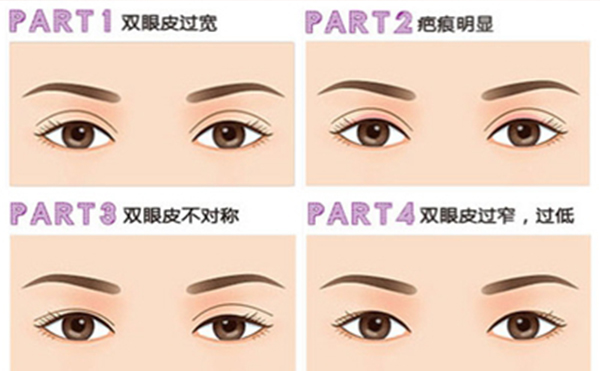 雙眼皮手術(shù)失敗如何修復(fù)呢?需要多長時(shí)間?