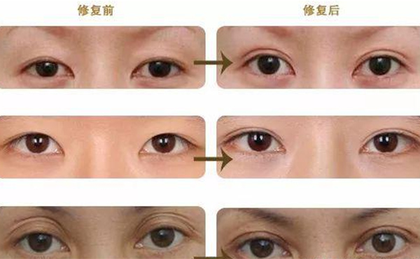 雙眼皮修復(fù)可靠嗎？什么時候做雙眼皮修復(fù)比較好？