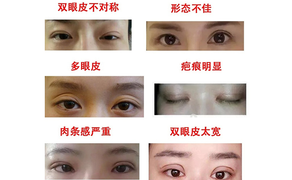 哪些情況需做雙眼皮修復？修復難度大不大?