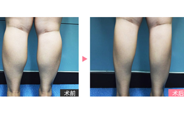 boxo瘦腿有什么優(yōu)勢？