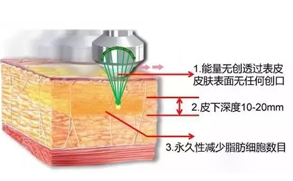 超聲波吸脂怎么瘦手臂？