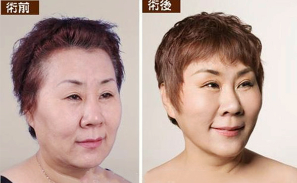 拉皮手術多久能恢復自然？