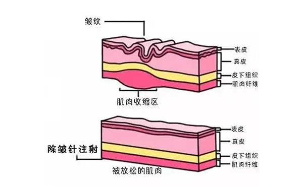 注射除皺是什么原理？